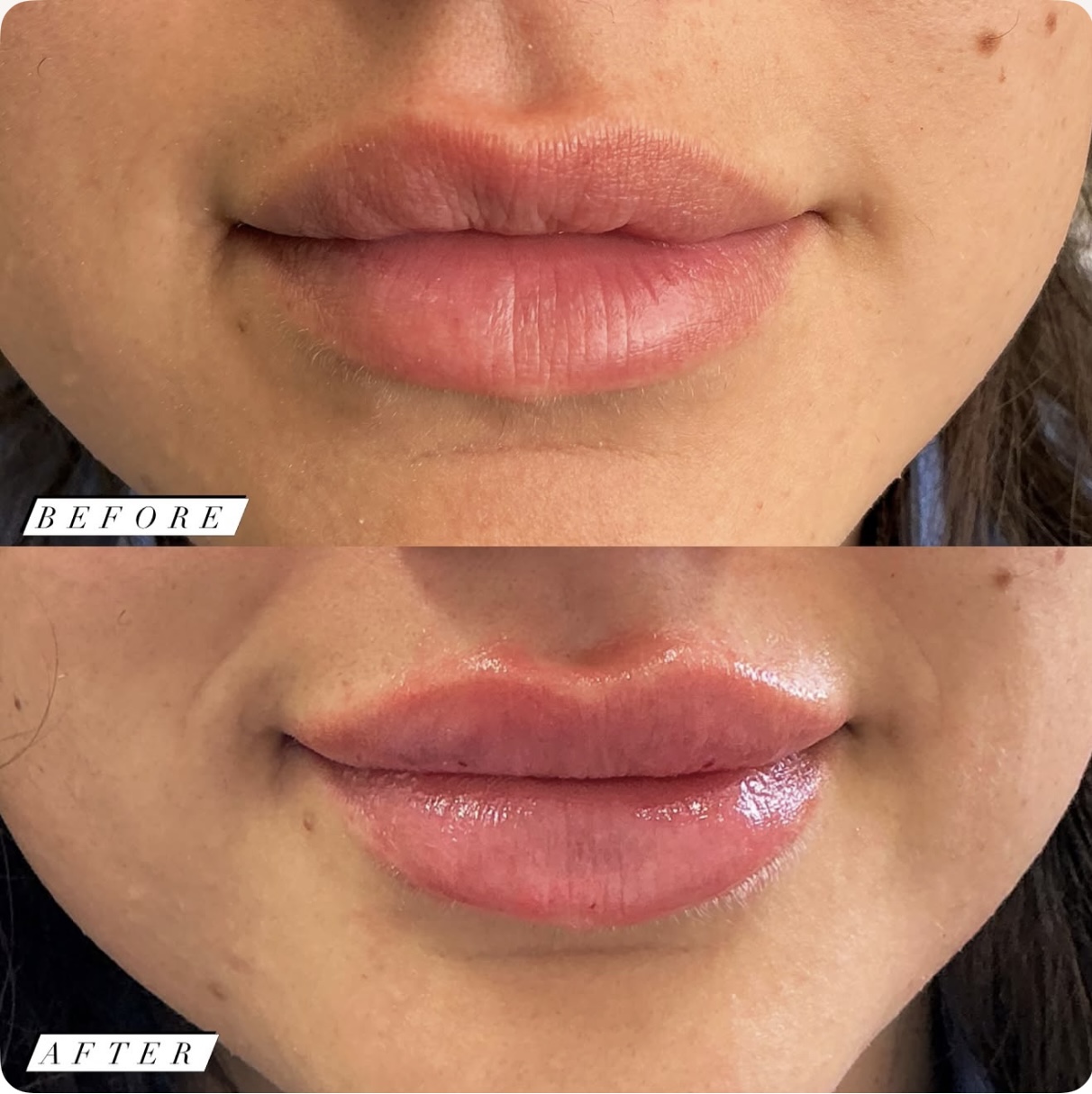 What Determines the Cost of One Syringe of Lip Filler?